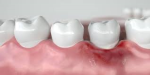 جرم‌ گیری لثه